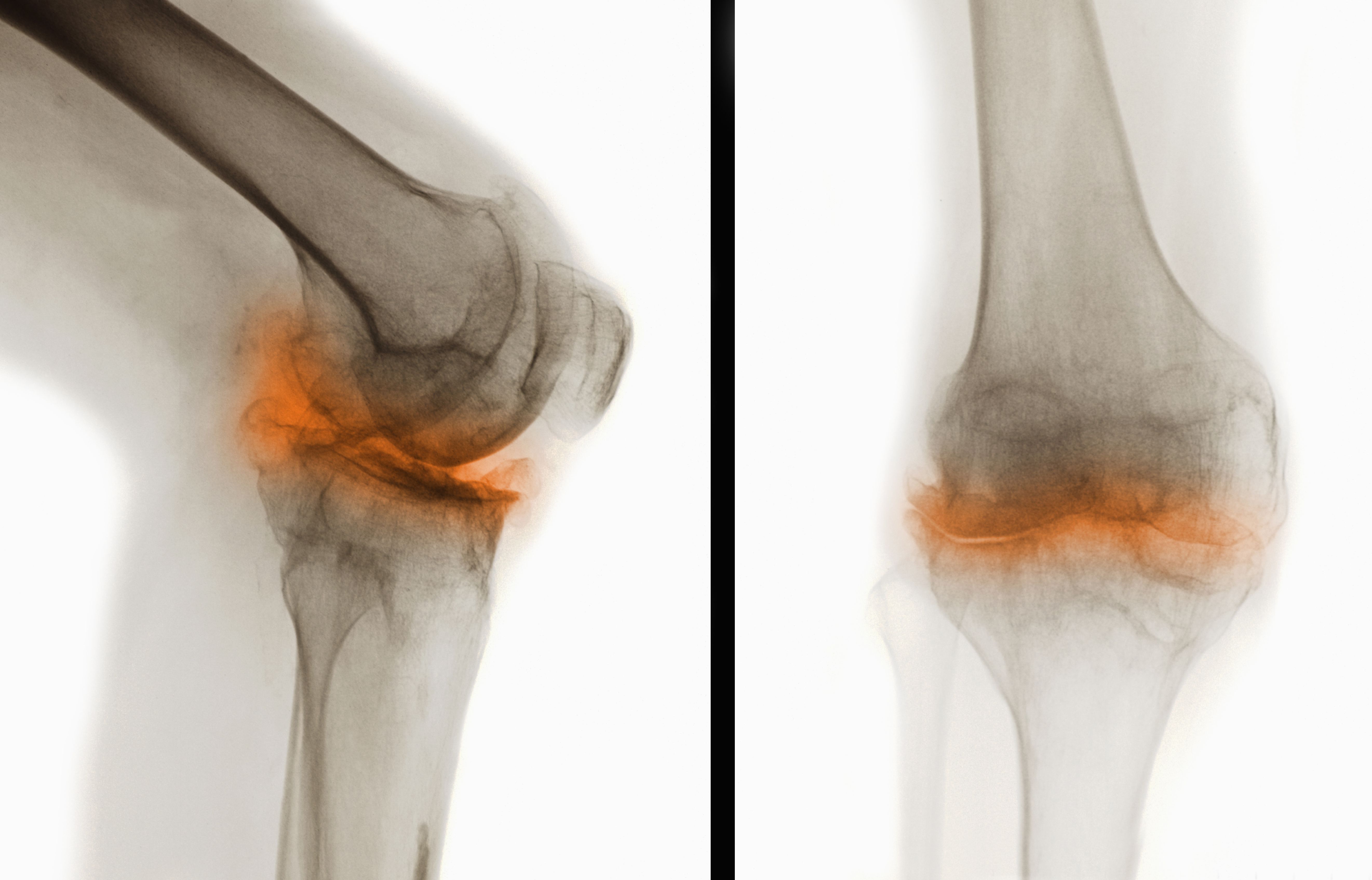 monoarticular-sero-negative-rheumatoid-arthritis