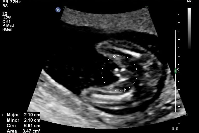 variable presentation at 18 weeks