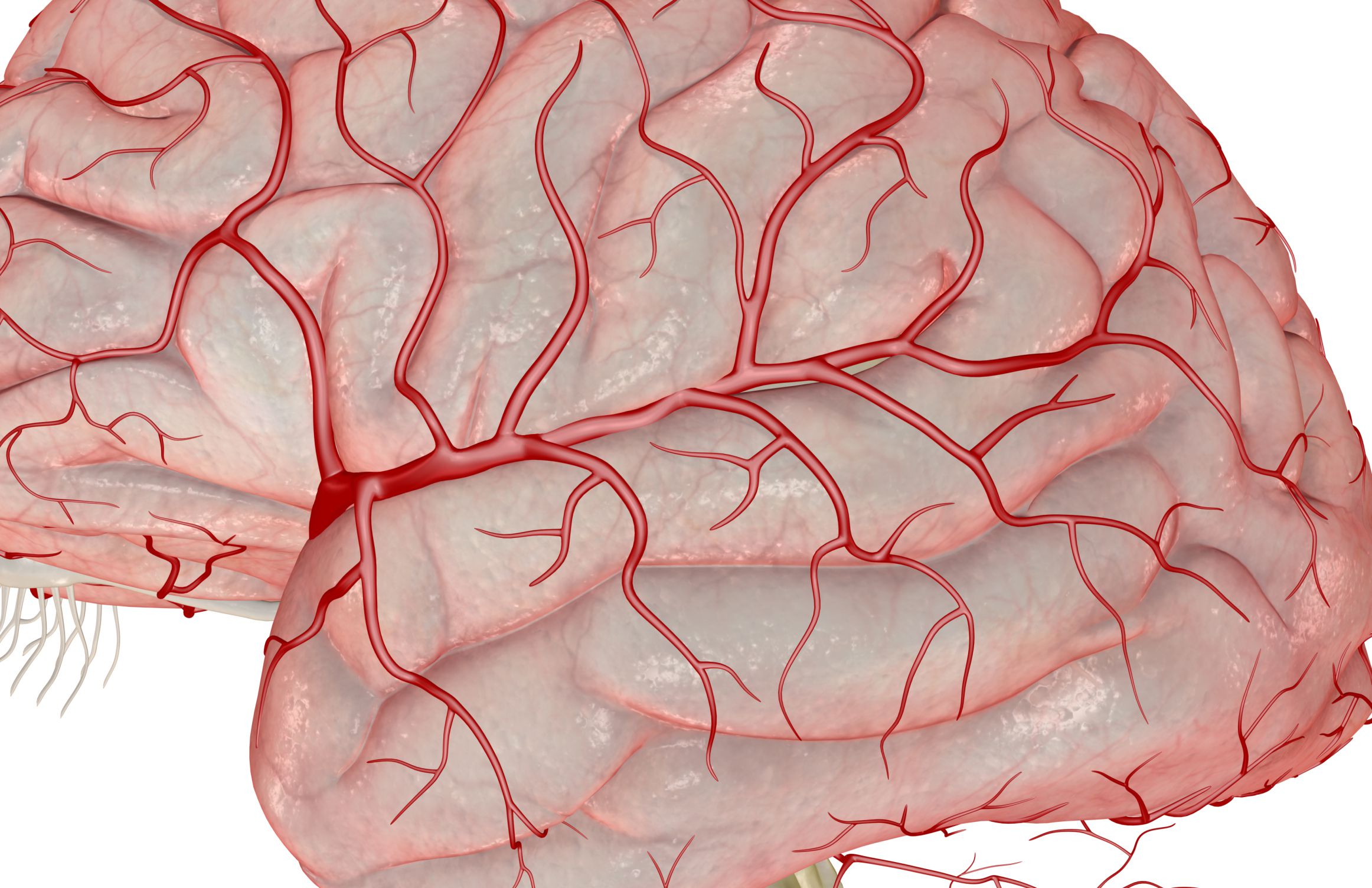 small-vessel-stroke-overview